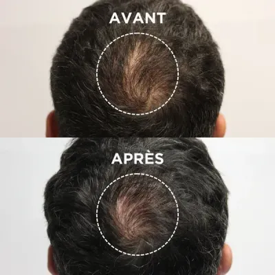 Antes e depois de calvície na parte de trás da cabeça