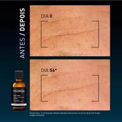 Antes e depois da aplicação do Daily Peel da Filorga na pele com quadro de manchas e rugas