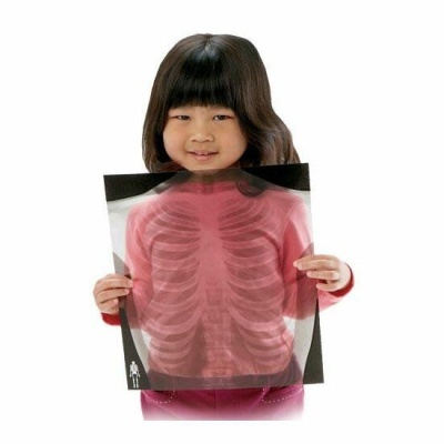 Menina com radiografia de tórax mostrando costelas