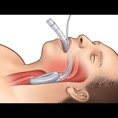Ilustração médica de um tubo endotraqueal inserido na traqueia