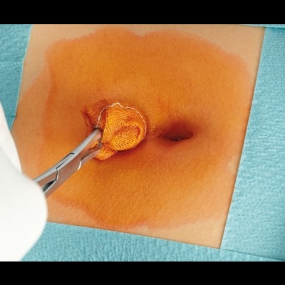 Procedimento médico com gaze laranja e campo estéril azul sobre pele adulta