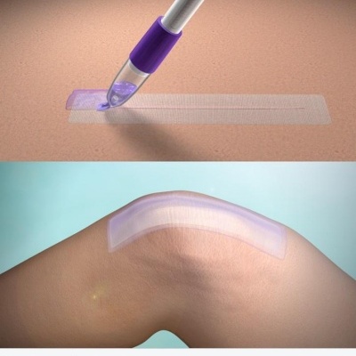 Caneta aplicadora com adesivo transparente sendo colocado na pele e adesivo aplicado num joelho