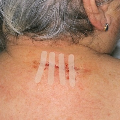 Parte superior das costas com cicatriz e tiras adesivas.