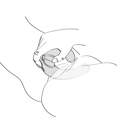 Aplicação de copo de ventosa transparente na pele