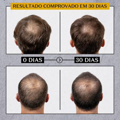 Antes e depois 30 dias de tratamento capilar mostrando aumento de densidade do cabelo.