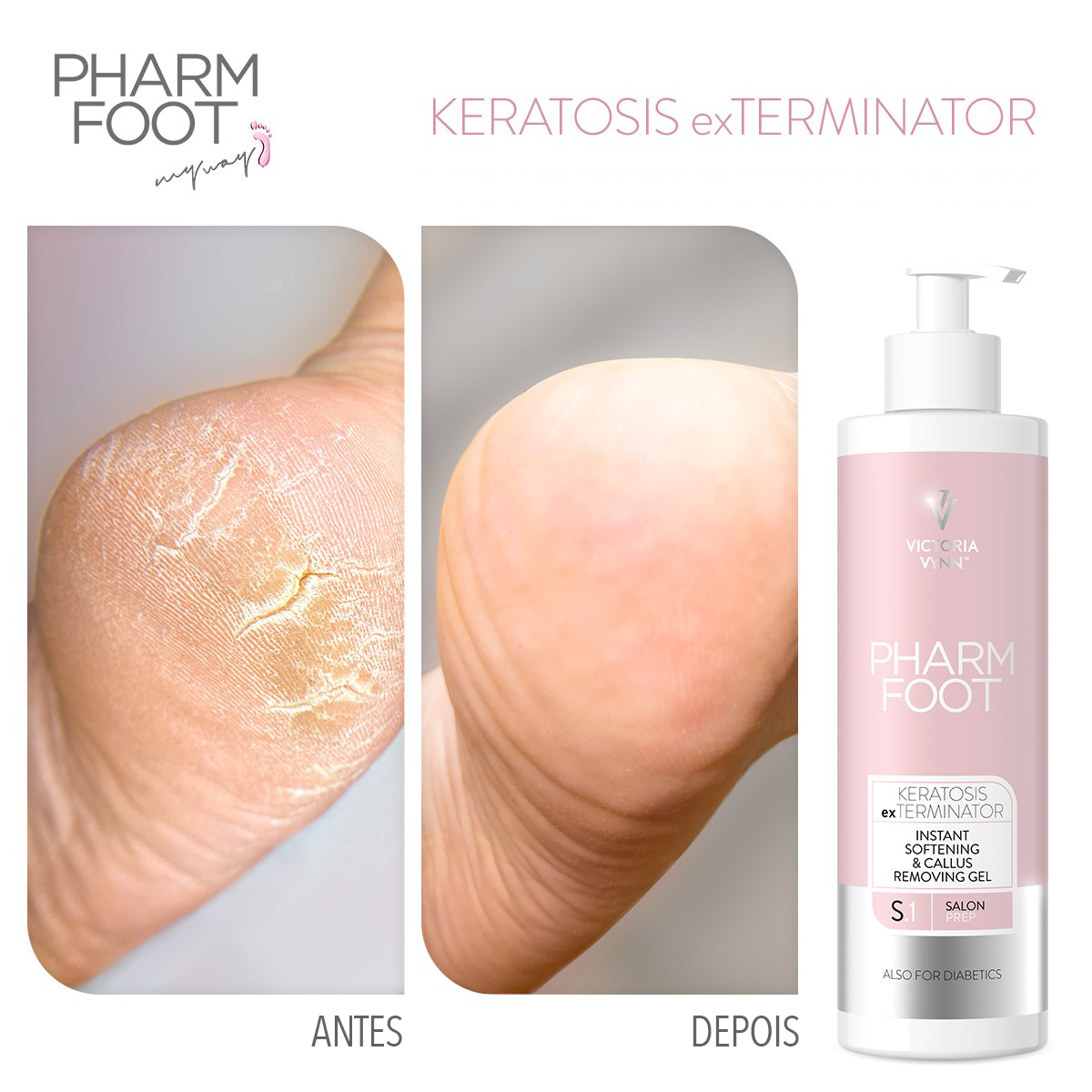 Victoria Vynn Pharm Foot All In - Keratosis Exterminator 300ml Antes e depois de calcanhar seco com gel esfoliante PHARM FOOT KERATOSIS exTERMINATOR
