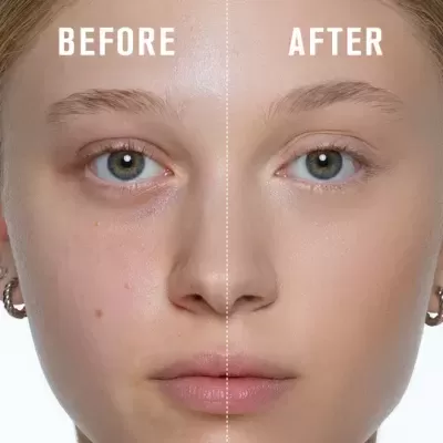 Rosto de mulher jovem dividido ao meio com comparação BEFORE e AFTER da pele