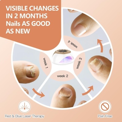 Imagens mostrando recuperação de unha doente ao longo de 4 semanas com dispositivo de laser vermelho e azul