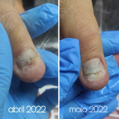 Dedo com unha danificada em abril 2022 e regenerada em maio 2022 segurado por luvas azuis