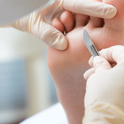 Mãos com luvas a segurar bisturi perto do pé numa clínica