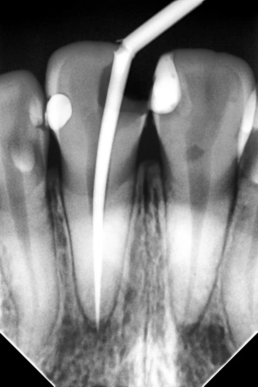 Cópia de Sensor de radiologia digital i-Sensor | H1.5: 43,5 × 29,2mm (1.270,2 mm2) Radiografia dentária com quatro dentes e instrumento no canal radicular