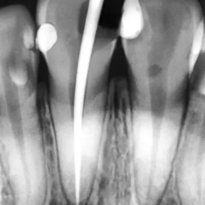 Radiografia dentária com quatro dentes e instrumento no canal radicular