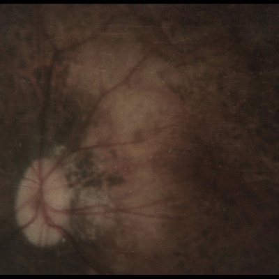 Imagem médica da retina humana com vasos sanguíneos e uma lesão esbranquiçada