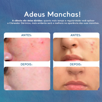 Cicatribem&#x20;-&#x20;Clareador&#x20;Manchas&#x20;Rosto&#x20;e&#x20;Corpo&#x20;D&#x00E9;rmico&#x2705;PRONTA&#x20;ENTREGA