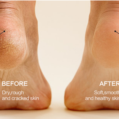 Calcanhares com pele seca antes e pele suave depois