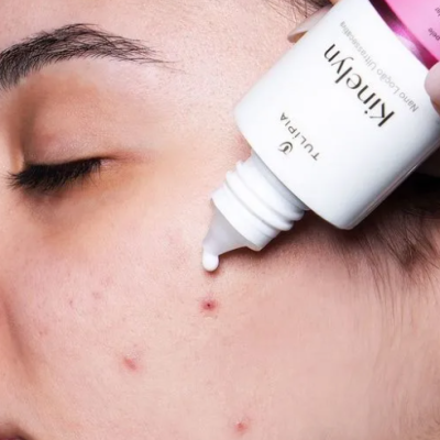 Aplicação de creme Kinclyn no rosto com acne