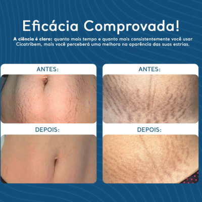 Comparação antes e depois do uso do Cicatribem para estrias