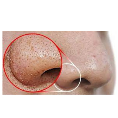 Nariz com poros dilatados e pontos negros destacados