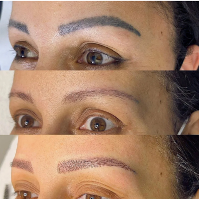 Kit&#x20;Remove&#x20;Confort&#x20;&#x2122;&#x20;-&#x20;Despigmenta&#x00E7;&#x00E3;o&#x20;Qu&#x00ED;mica