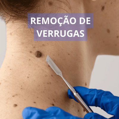 Zero&#x20;Dor&#x20;Pele&#x20;Fechada&#x20;&#x2122;&#x20;-&#x20;Dessensibilizante&#x20;Micropigmenta&#x00E7;&#x00E3;o